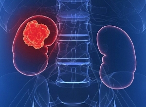 Ung thư thận giai đoạn 1 sống được bao lâu? Những điều người bệnh nên biết